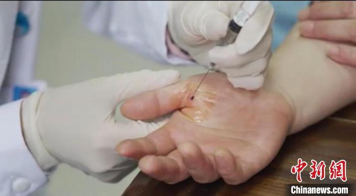 嘉善群眾體驗(yàn)小針刀?！〖紊平y(tǒng)戰(zhàn) 供圖