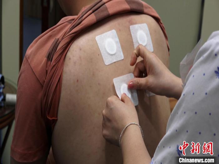 圖為醫(yī)生正在為民眾貼“三伏貼”。　唐蔚晴 攝